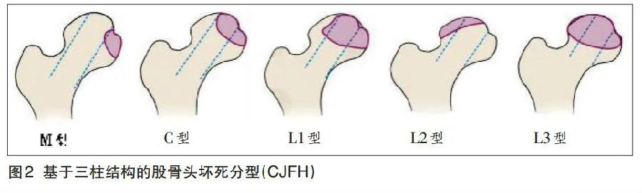 对症解顽疾丨股骨头坏死，保髋还是置换？不如用中药治疗同样有效！