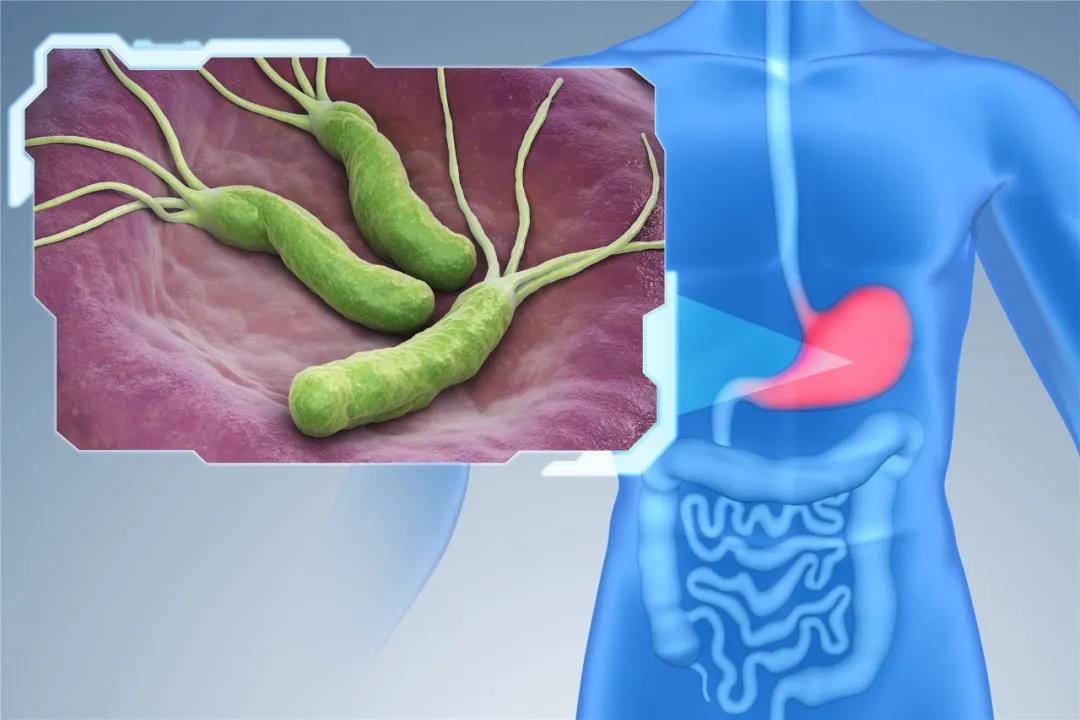 致癌？据明珠医院检验统计：每5人就有1个感染，该如何治疗？